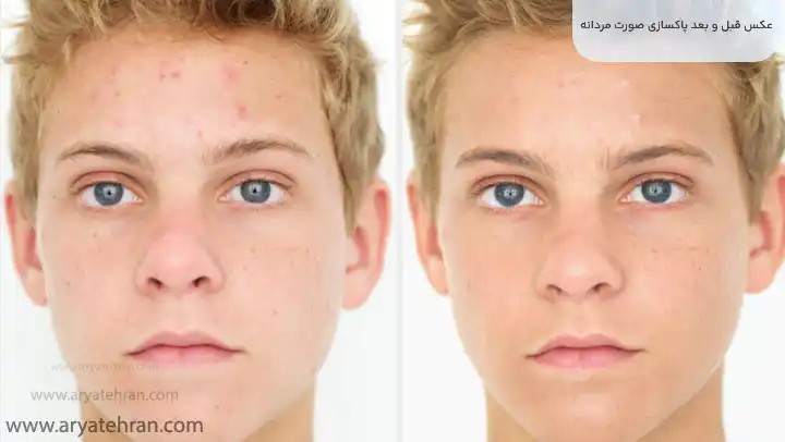 عکس قبل و بعد پاکسازی صورت مردانه