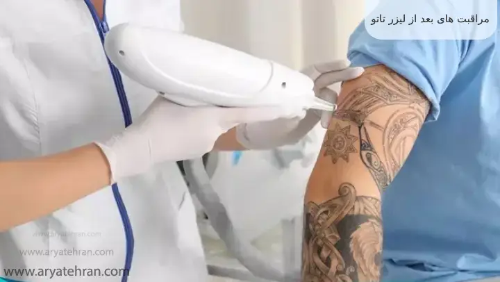 مراقبت های بعد از لیزر تاتو