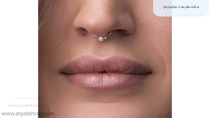 مراقبت های بعد از میکرودرمال