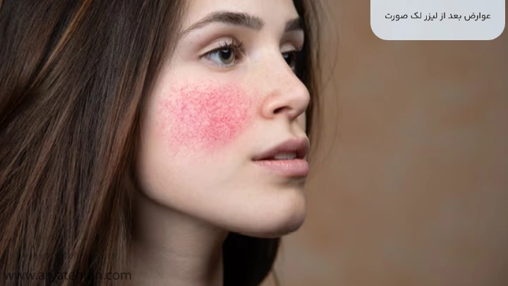 عوارض بعد از لیزر لک صورت