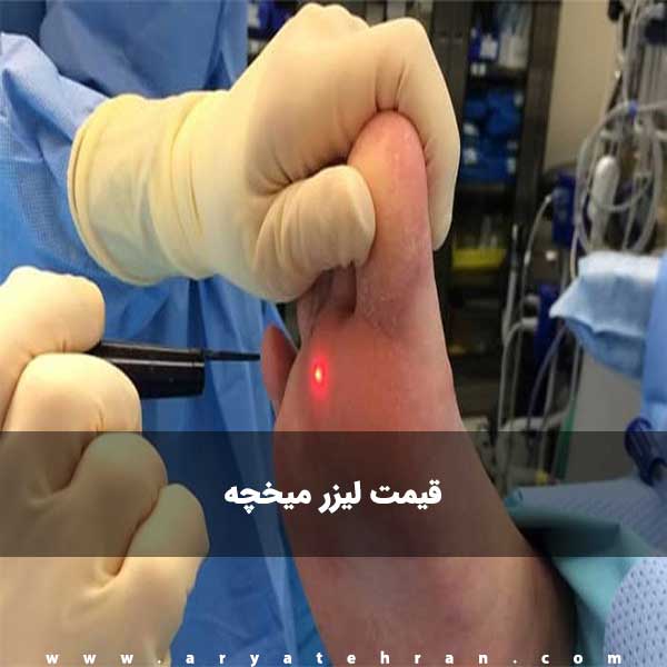 قیمت لیزر میخچه پا و دست | مرکز جراحی میخچه پا در تهران