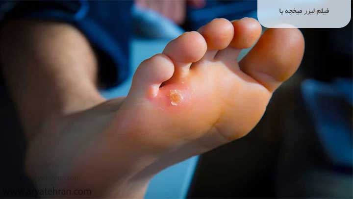 فیلم لیزر میخچه پا