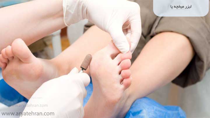 لیزر میخچه پا