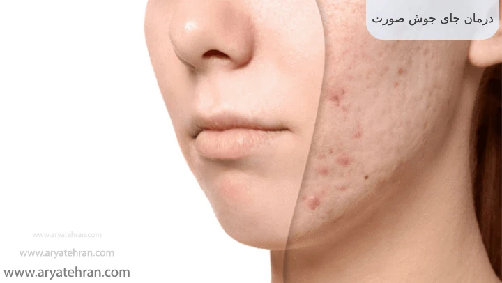 درمان جای جوش صورت