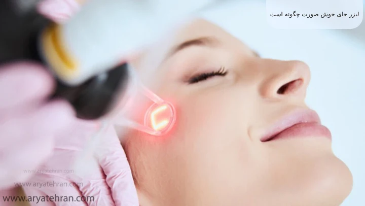 لیزر جای جوش صورت چگونه است