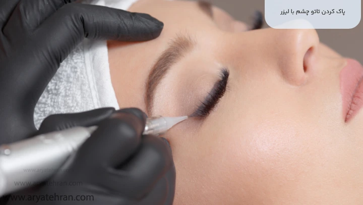 پاک کردن تاتو چشم با لیزر