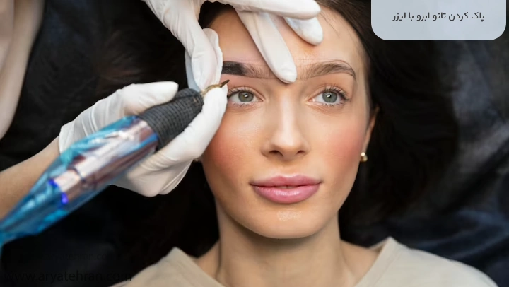 پاک کردن تاتو ابرو با لیزر