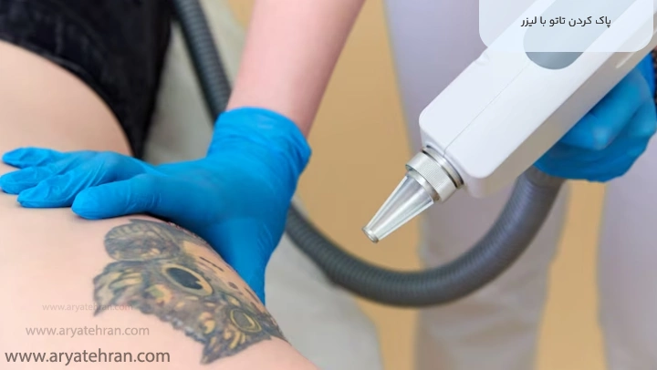پاک کردن تاتو با لیزر