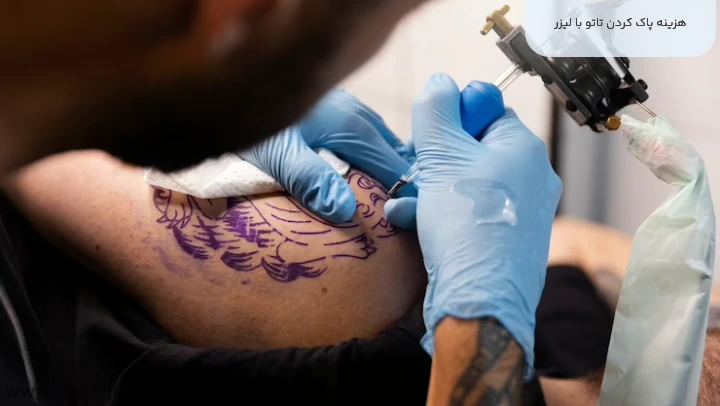 هزینه پاک کردن تاتو با لیزر