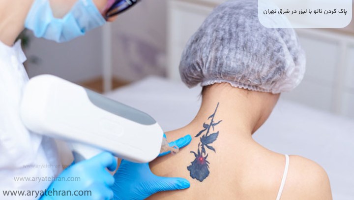پاک کردن تاتو با لیزر در شرق تهران