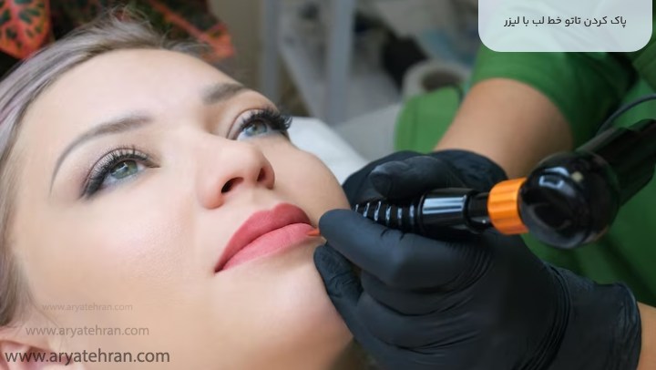 پاک کردن تاتو خط لب با لیزر