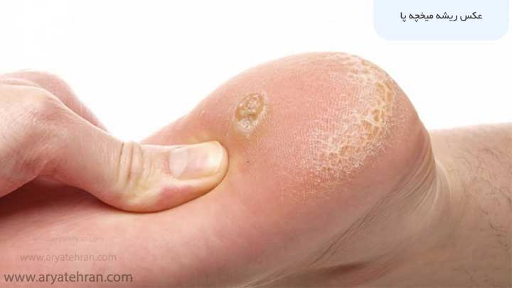 عکس ریشه میخچه پا