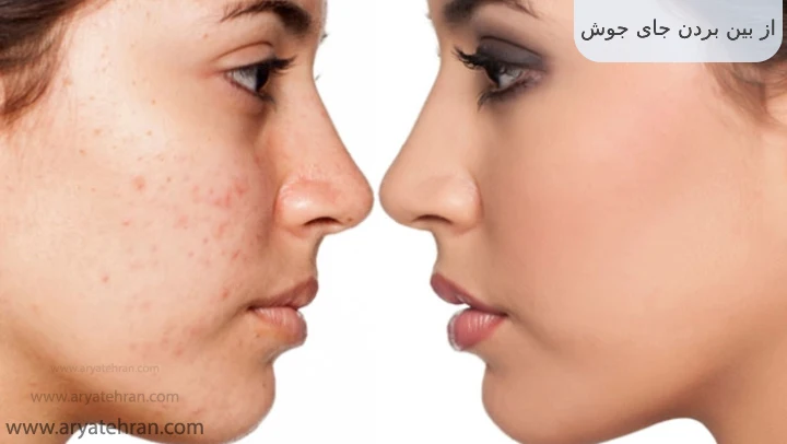 از بین بردن جای جوش