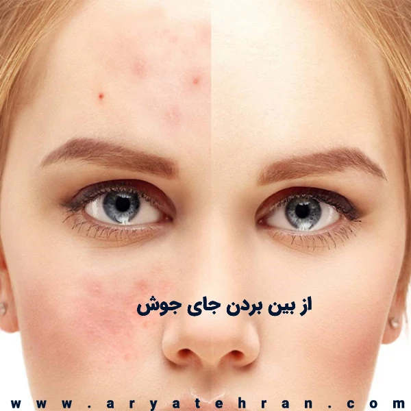 سریعترین روش از بین بردن جای جوش چیست | درمان قطعی جای جوش
