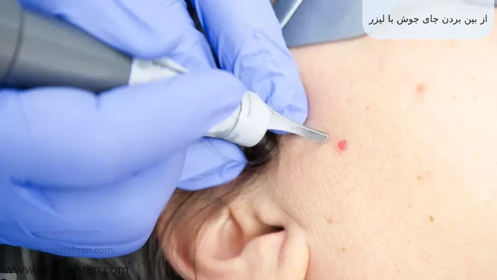 از بین بردن جای جوش با لیزر