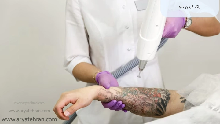 پاک کردن تتو