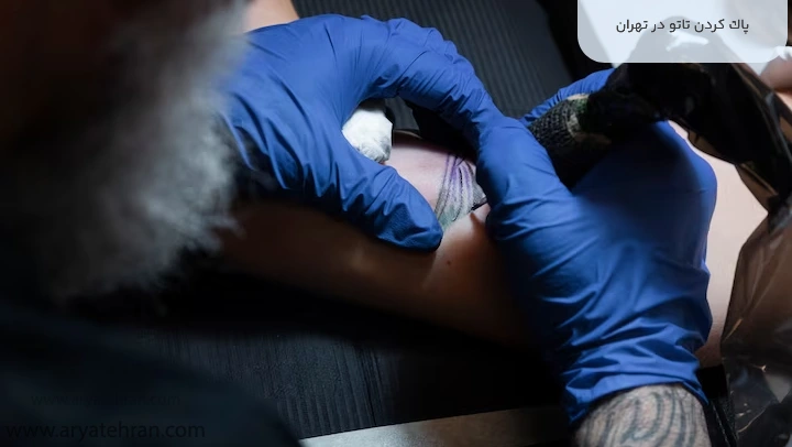 پاک کردن تاتو در تهران