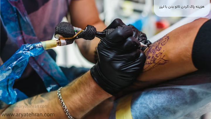 هزینه پاک کردن تاتو بدن با لیزر