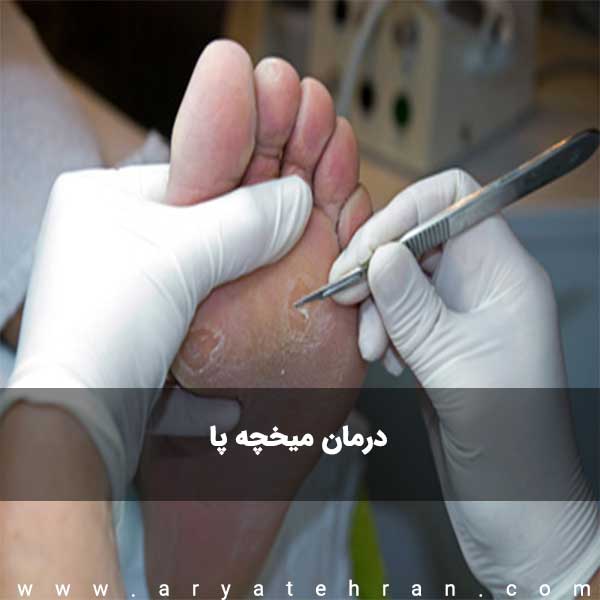 درمان میخچه پا