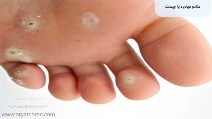 علائم میخچه پا چیست