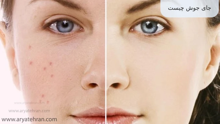 جای جوش چیست