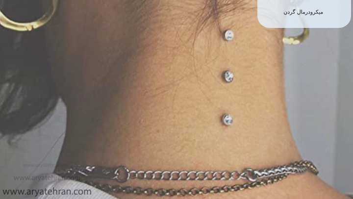 میکرودرمال گردن