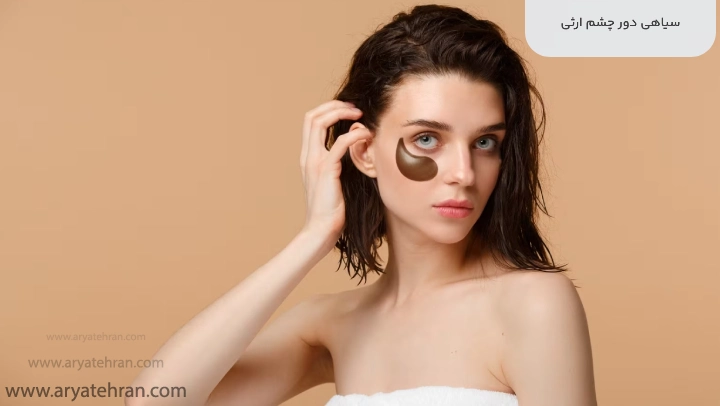 سیاهی دور چشم ارثی