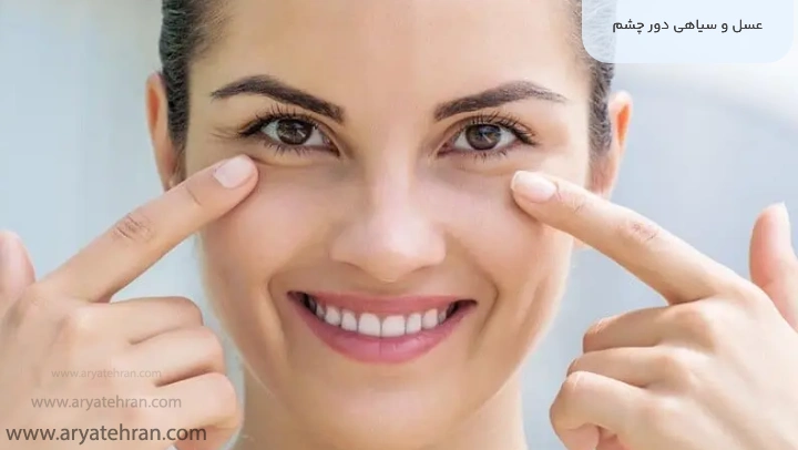 عسل و سیاهی دور چشم