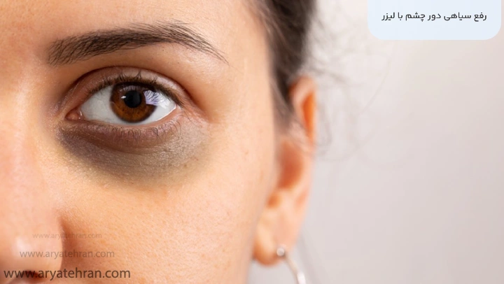 رفع سیاهی دور چشم با لیزر
