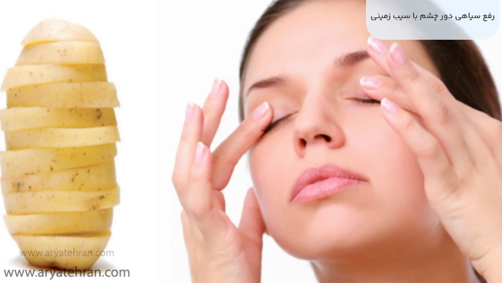 رفع سیاهی دور چشم با سیب زمینی