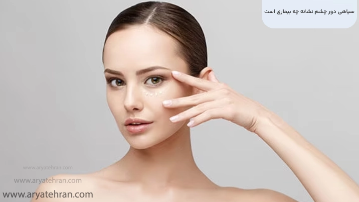 سیاهی دور چشم نشانه چه بیماری است