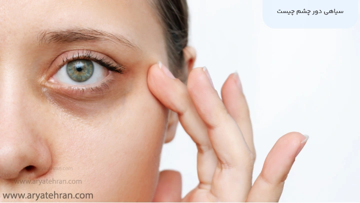 سیاهی دور چشم چیست