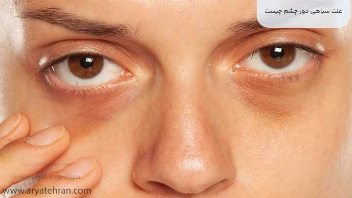 علت سیاهی دور چشم چیست