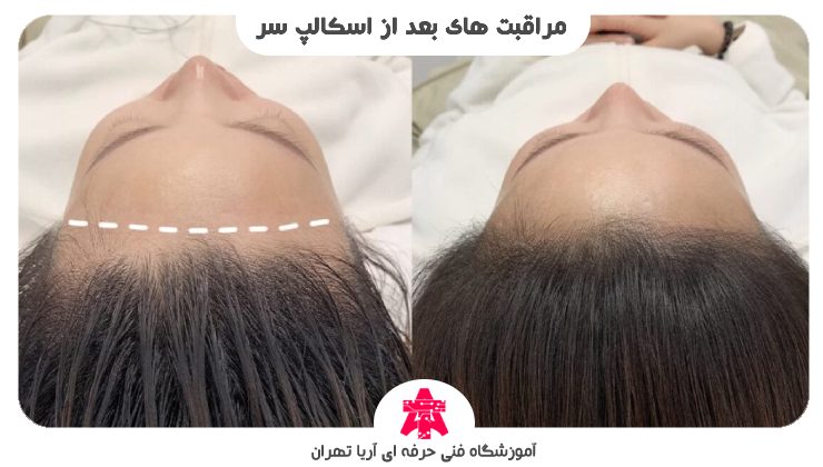 مراقبت های بعد از اسکالپ سر