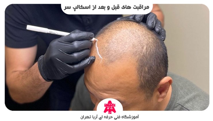 مراقبت های قبل و بعد از اسکالپ سر