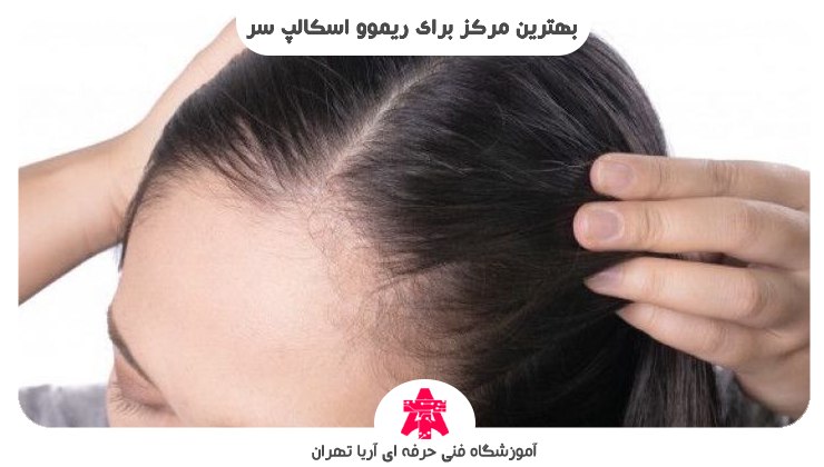 بهترین مرکز برای ریموو اسکالپ سر