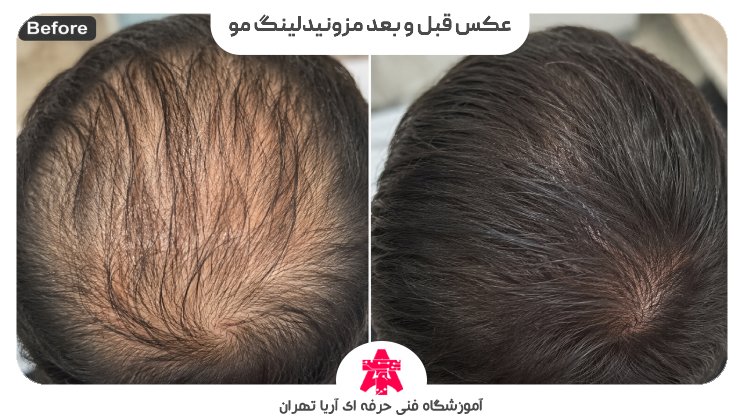 عکس قبل و بعد مزونیدلینگ مو