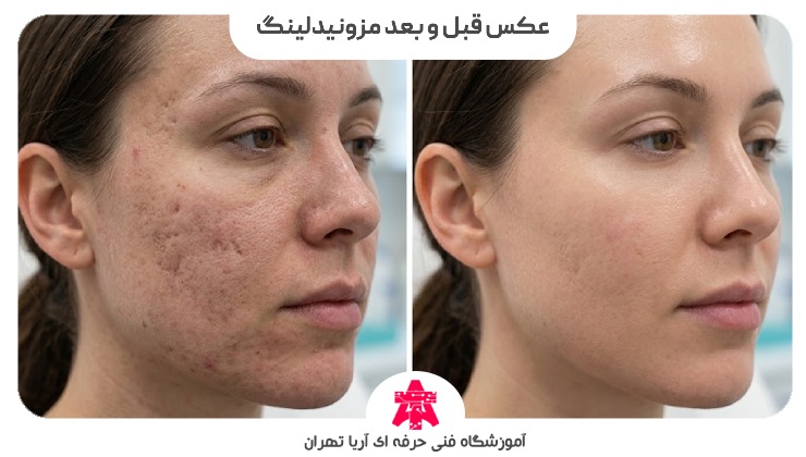 عکس قبل و بعد مزونیدلینگ